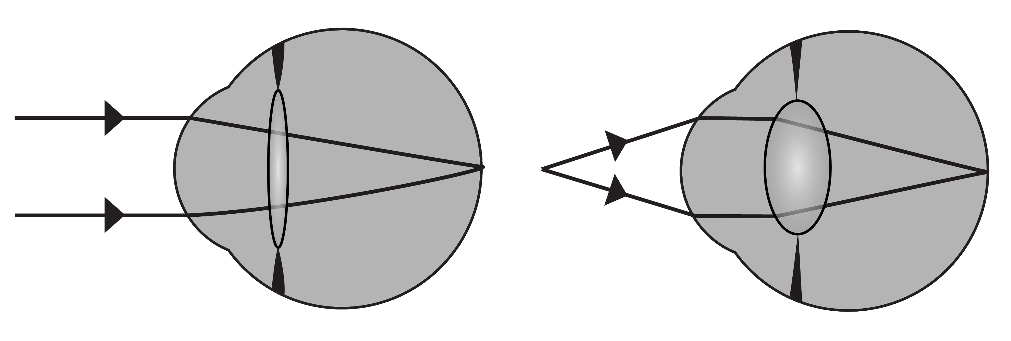Two ray diagrams comparing focus on the retina for distant and near objects as the eye accommodates.