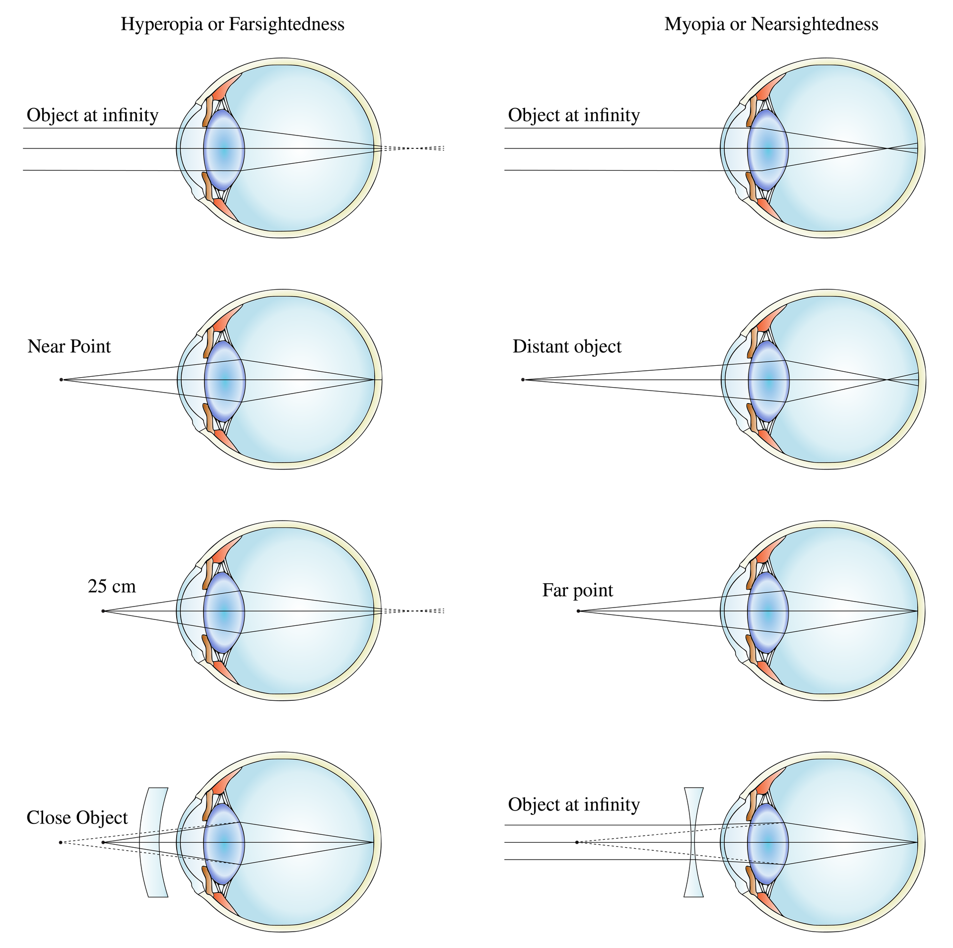 Ray diagrams showing how a converging lens corrects hyperopia and a diverging lens corrects myopia.